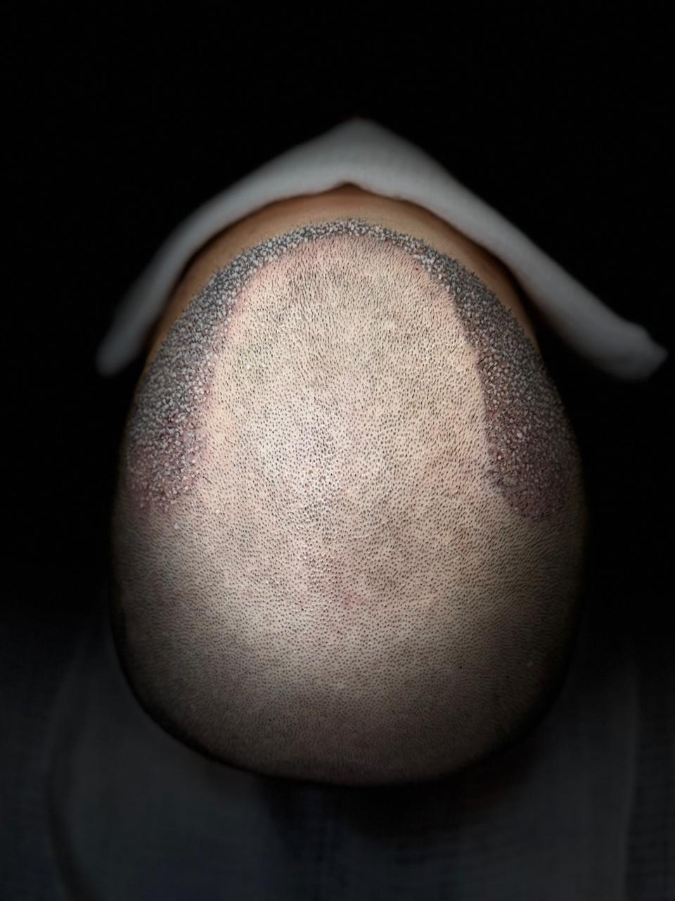 Antes do transplante - área receptora