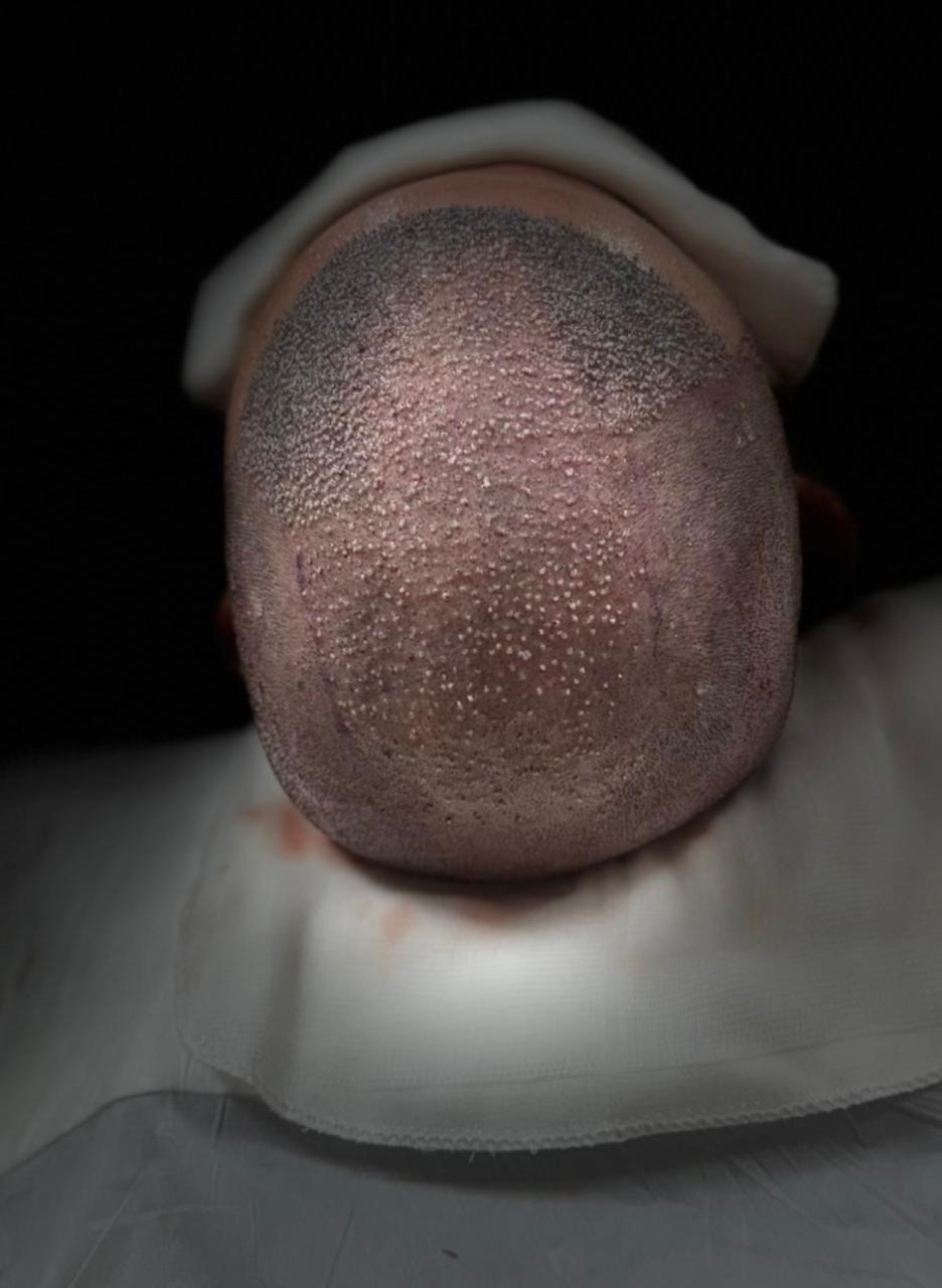 Pós-implante de grafts