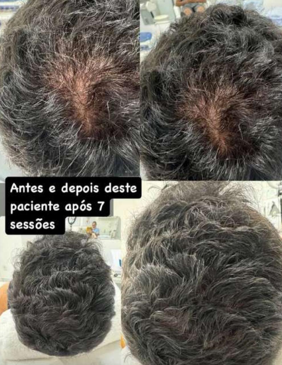Antes e depois após 7 sessões