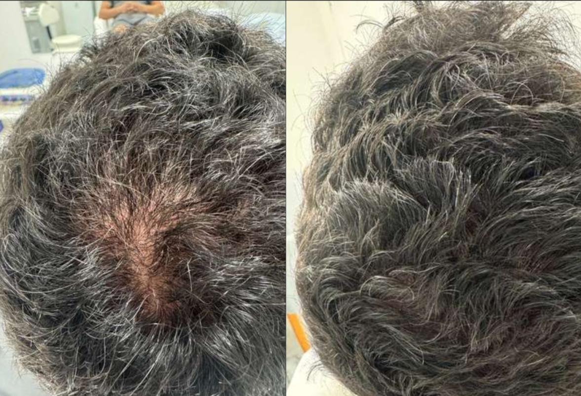 Antes e depois - masculino