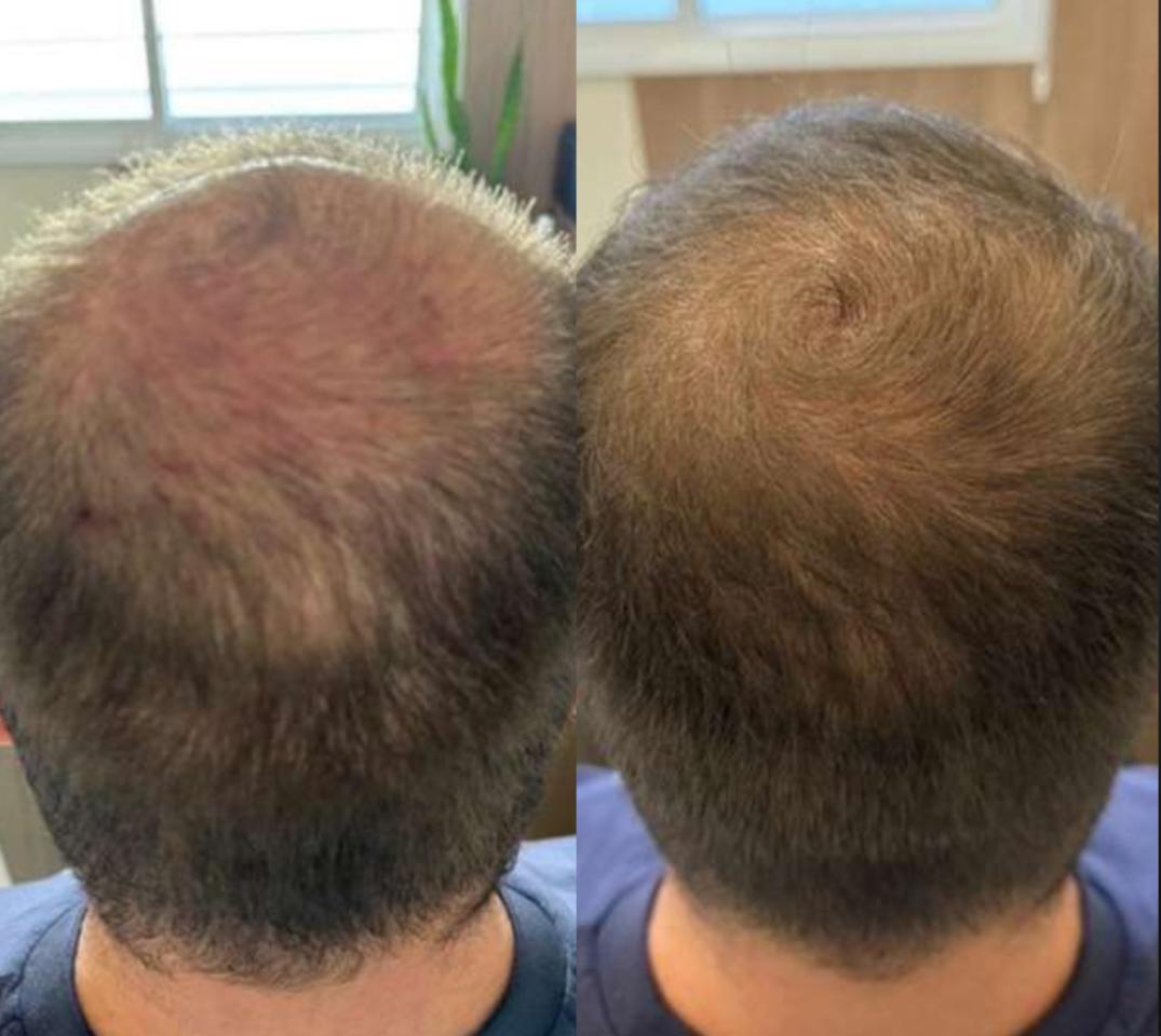 Antes e depois - masculino