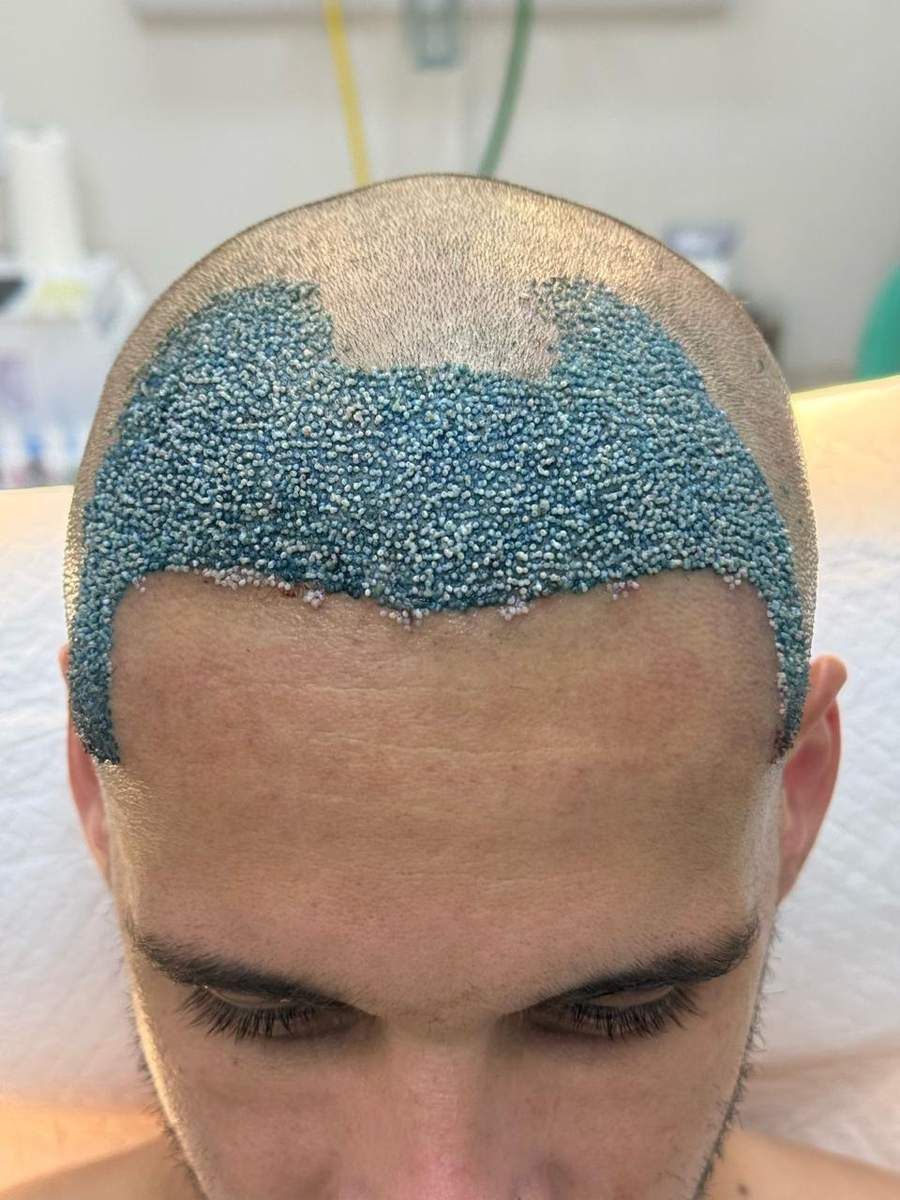 Transplante Capilar FUE - Implante frontal