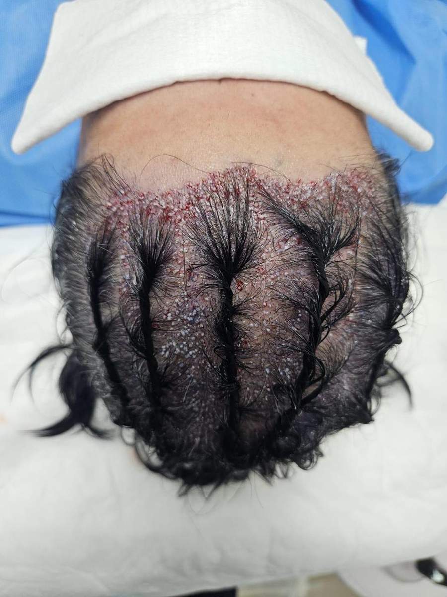 Transplante de Barba FUE